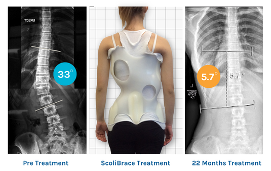 ScoliBalance scoliosis rehabilitation results